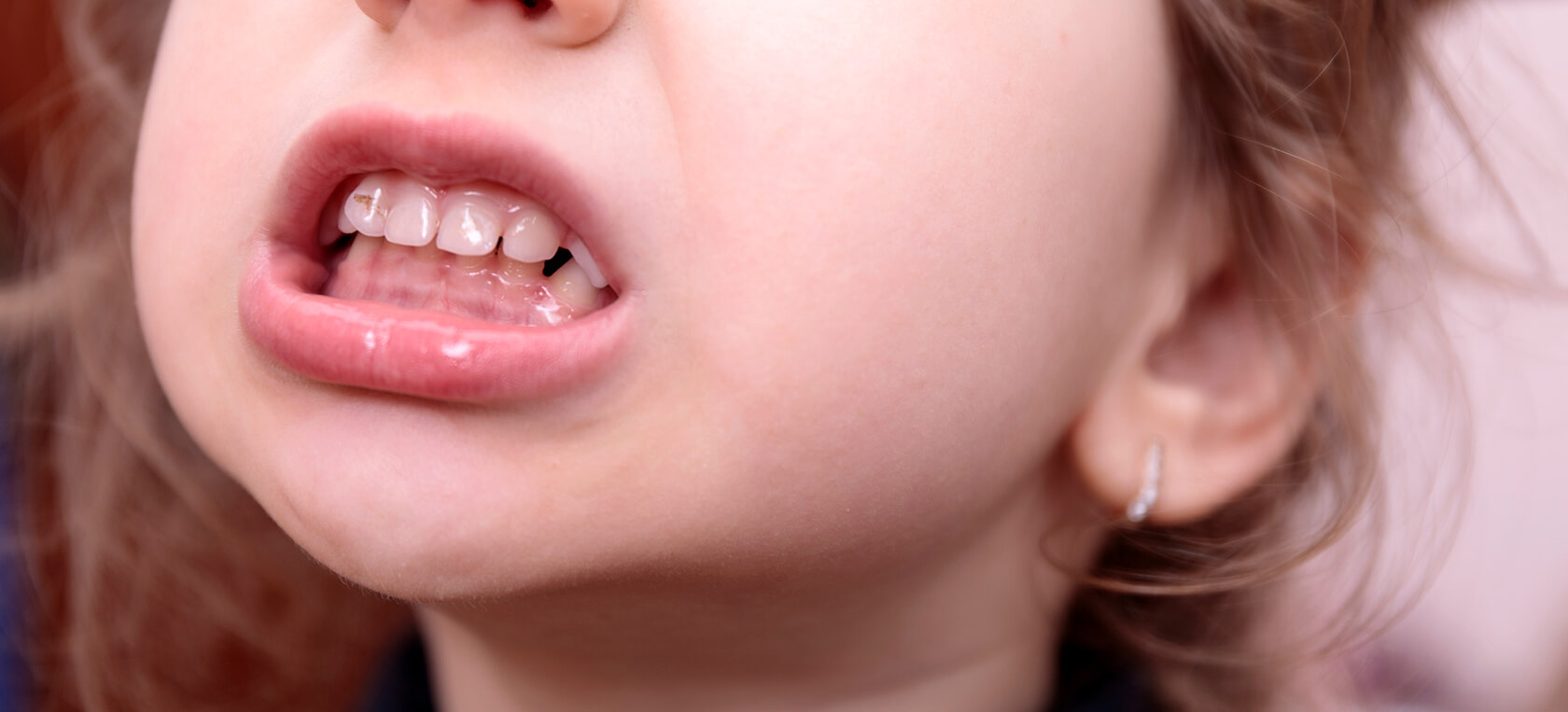 Ağızdan Nefes Almanın Çene Yapısına Zararları